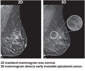 3D breast tomosynthesis